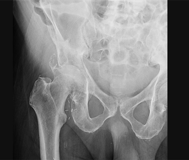 Pathological acetabular fracture and superior migration of the femoral head