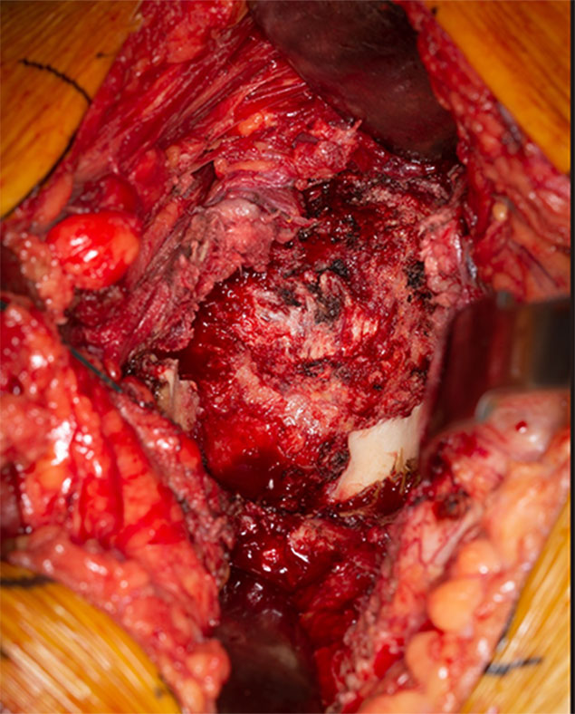 Superior and posterior acetabular bone loss