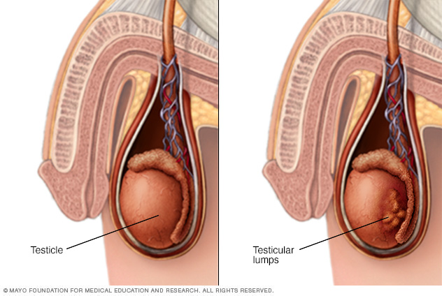 Testicular lumps