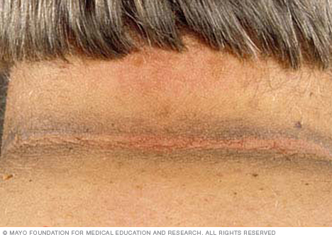 Photo of acanthosis nigricans 
