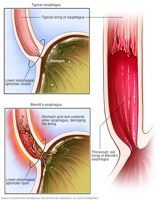 Illustration showing Barrett's esophagus