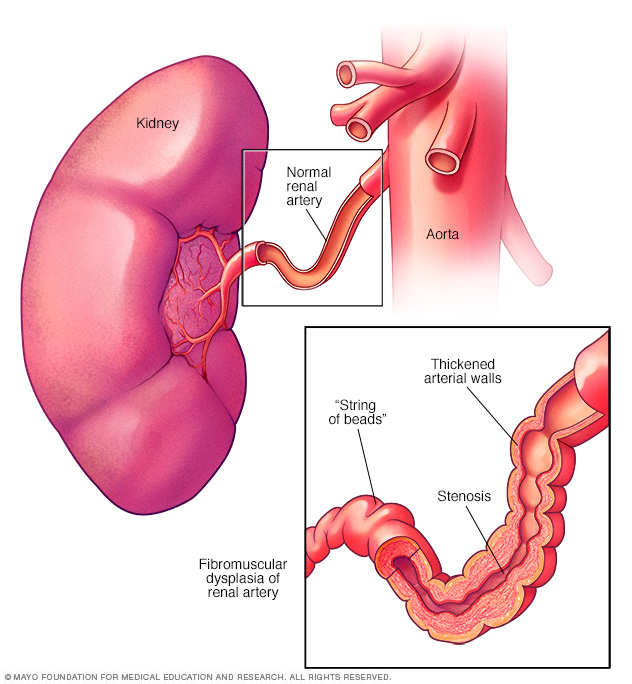 Fibromuscular dysplasia