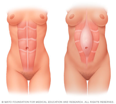 Separation of the abdominal muscles during pregnancy 