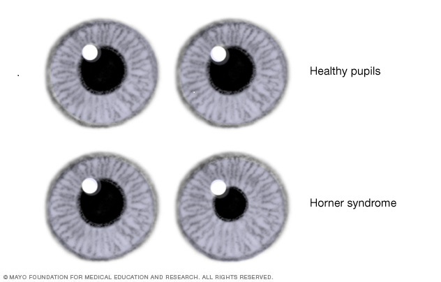 Horner syndrome signs