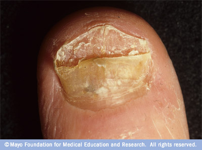 Photo of an infected nail
