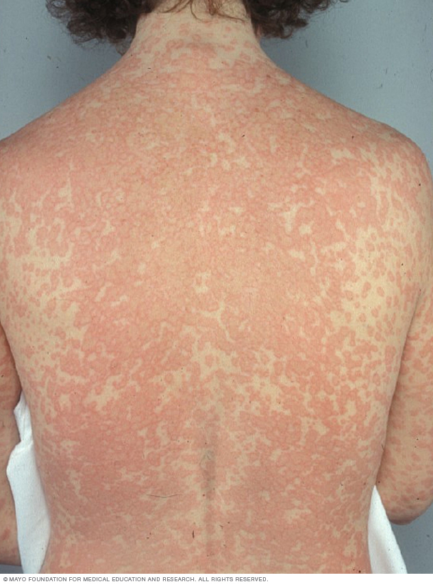 Rash caused by drug allergy