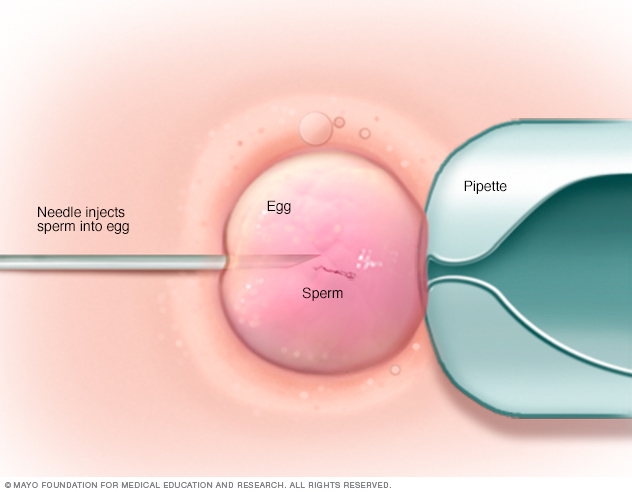 Illustration showing intracytoplasmic sperm injection (ICSI)