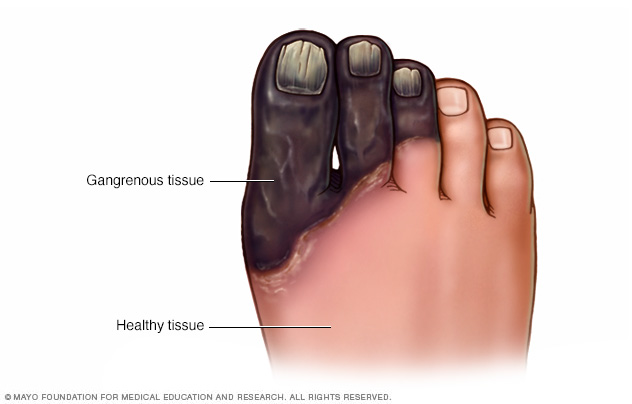 Gangrene of the foot