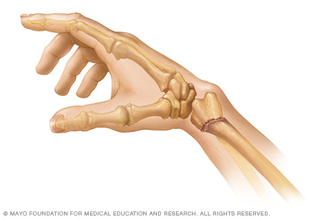 Colles' fracture