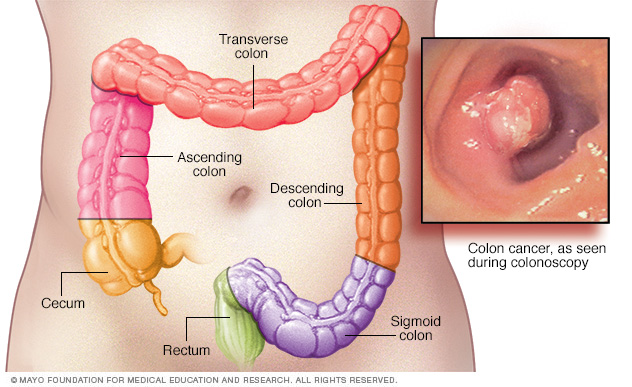 Colon cancer locations 