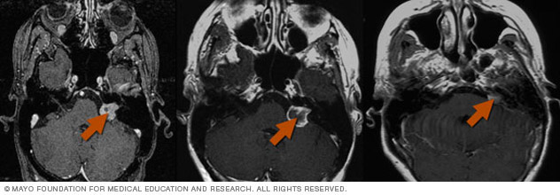 Gamma Knife radiosurgery results