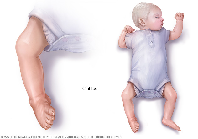 Baby with clubfoot