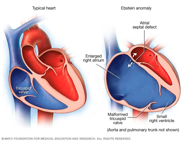 Ebstein anomaly