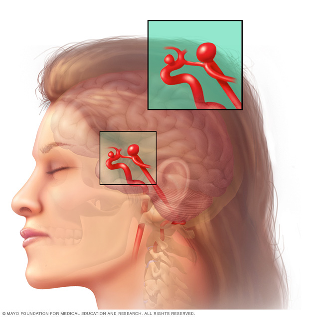 Brain aneurysm