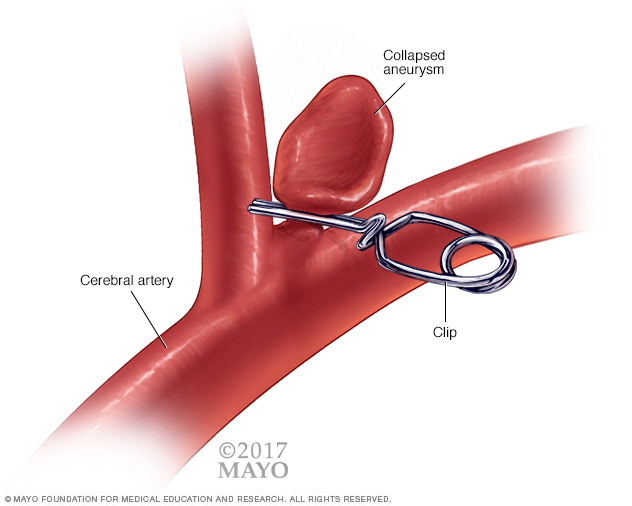 Aneurysm clip