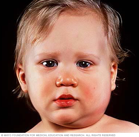 Child with mumps