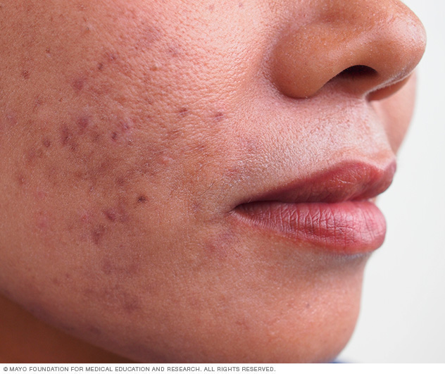 Common acne