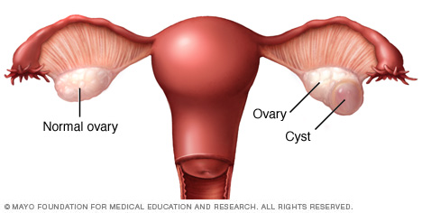 Corpus luteum cyst on ovary