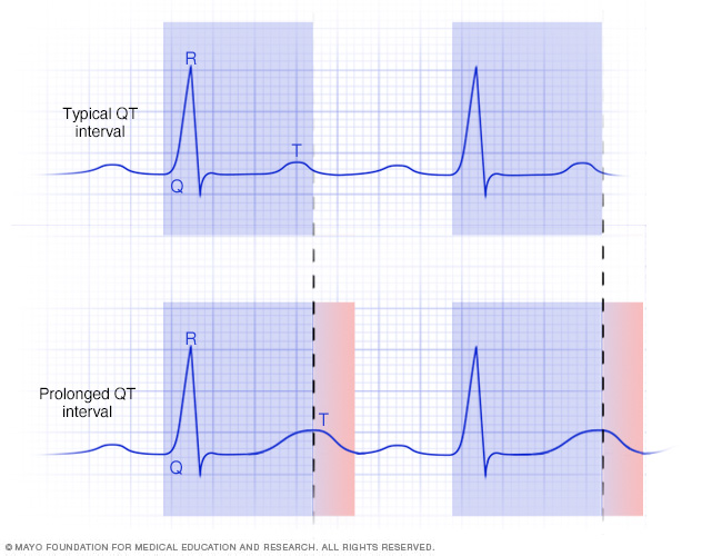 Graphs of typical and prolonged QT intervals