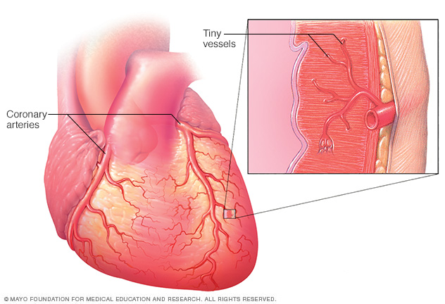 Small vessel disease