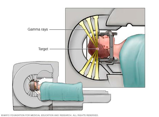 Gamma Knife targeting