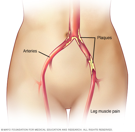 Claudication