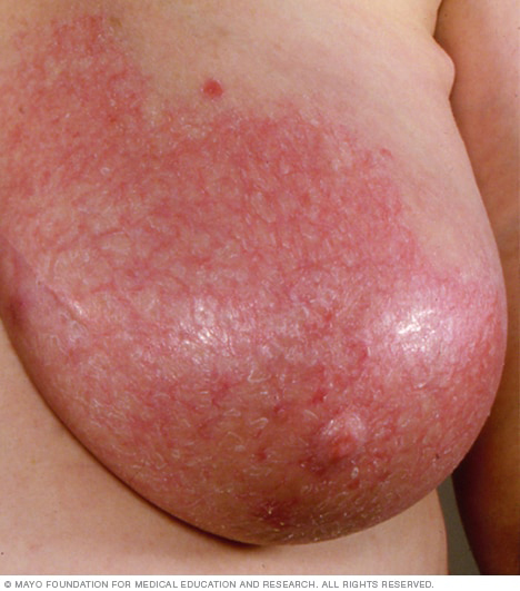 A woman with mastitis