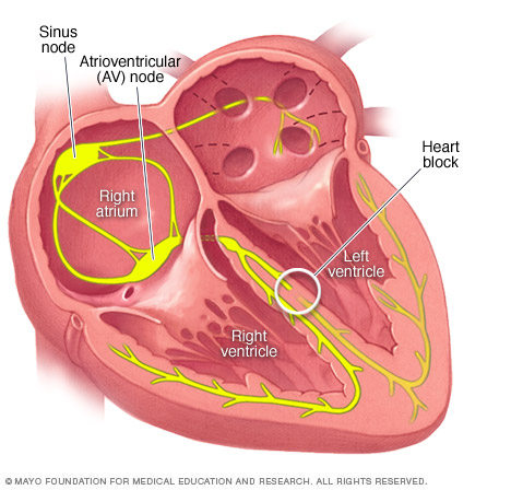 Bundle branch block 