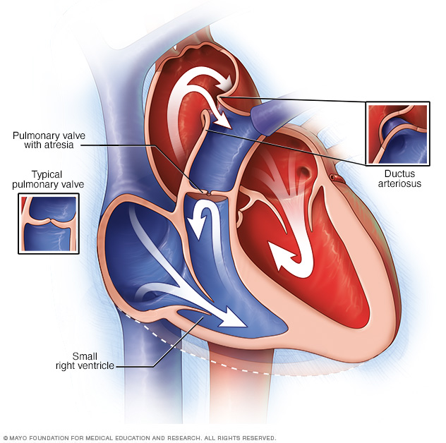 Pulmonary atresia