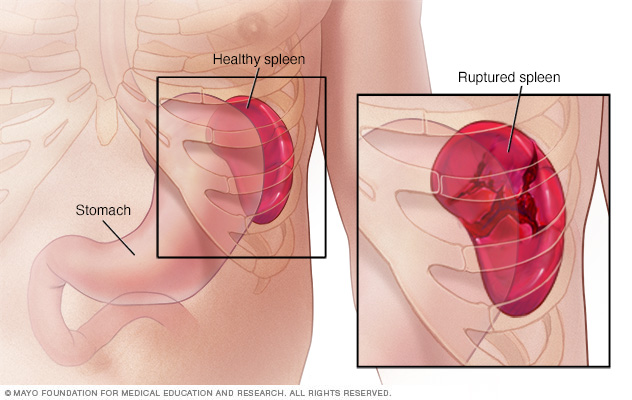 Ruptured spleen