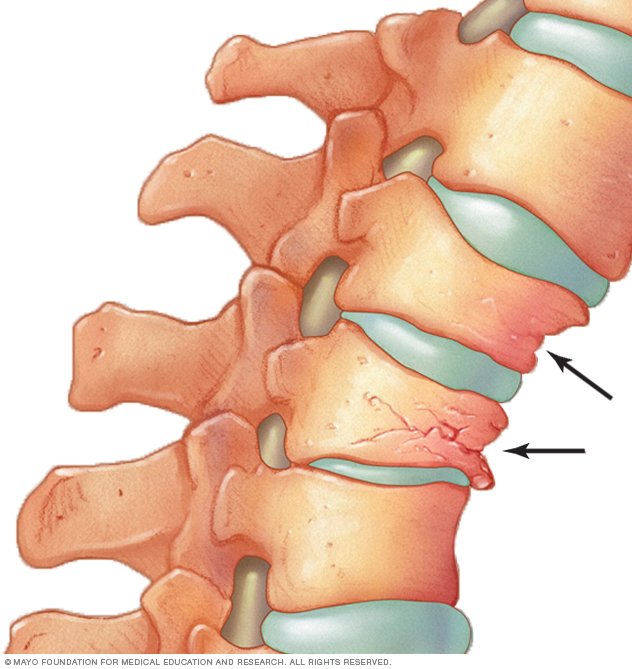 How osteoporosis can cause vertebrae to crumple and collapse