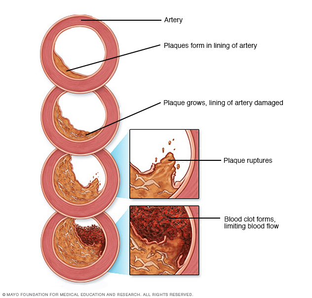 Development of atherosclerosis