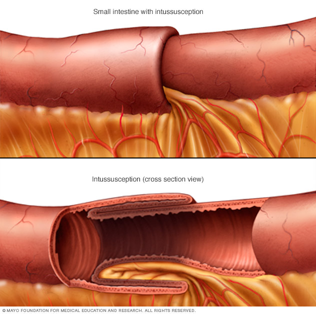 Intussusception