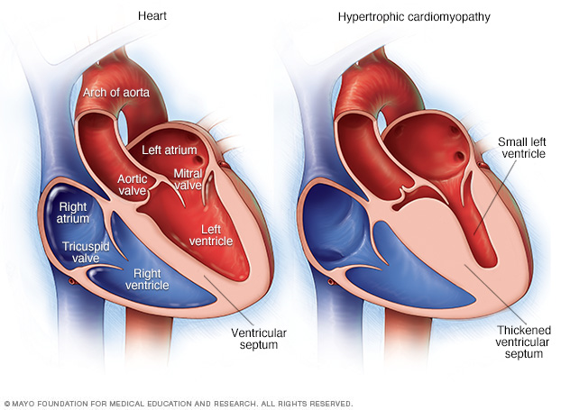 Hypertrophic cardiomyopathy