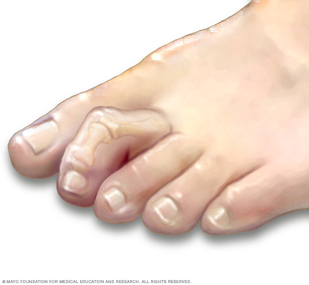 Hammertoe