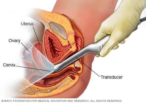 Transvaginal ultrasound