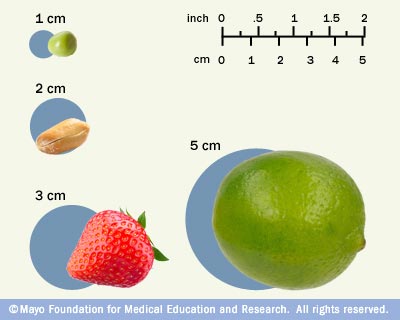 Illustration depicting tumor size 
