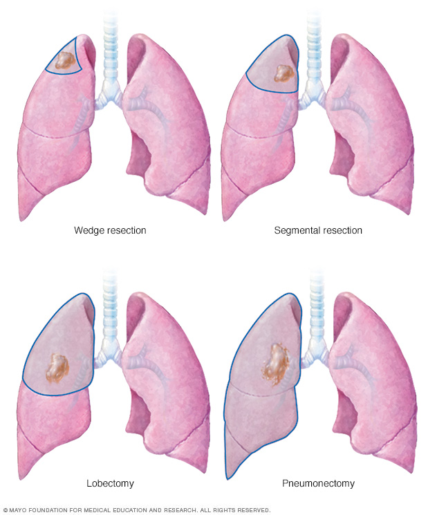 Lung cancer surgery