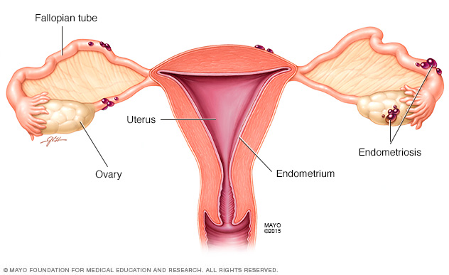 Endometriosis deposits on uterus and ovaries