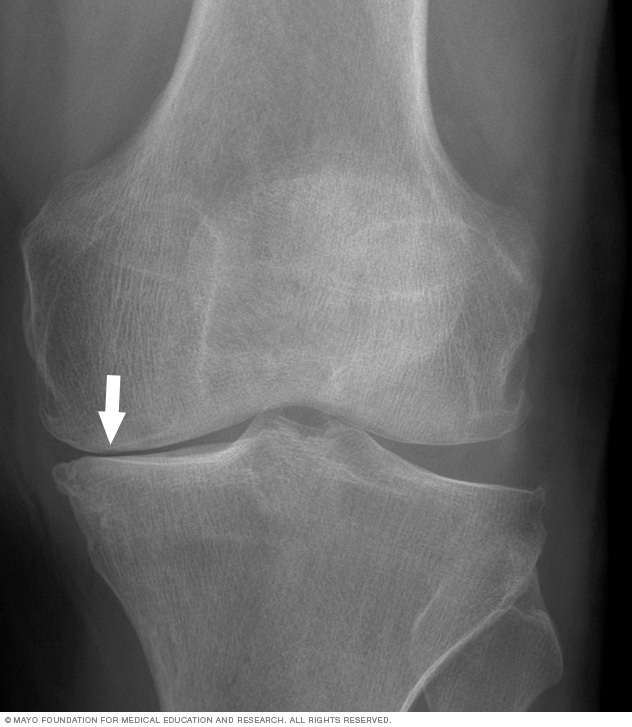 X-ray of knee arthritis