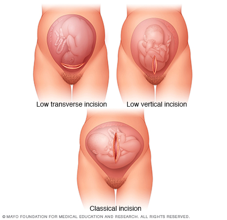 Uterine incisions used during C-sections