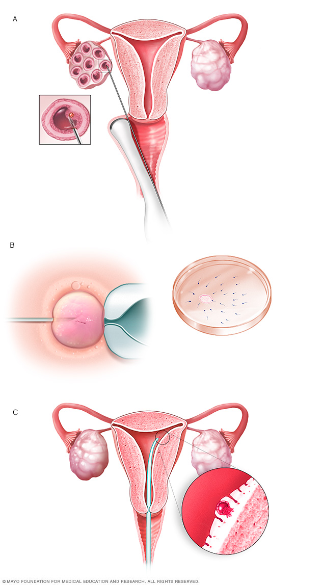 In vitro fertilization