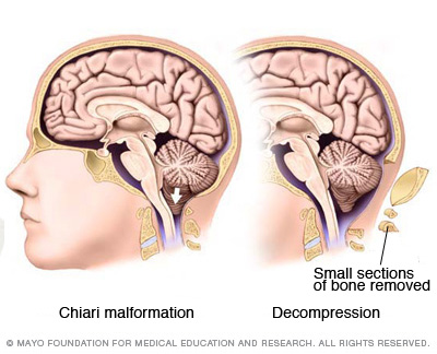 Chiari malformation