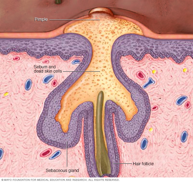 How acne develops