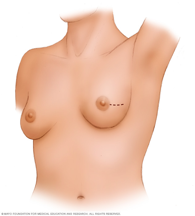 Lumpectomy