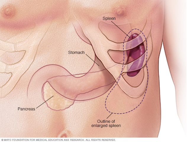 Enlarged spleen