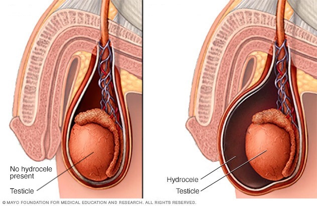 Hydrocele