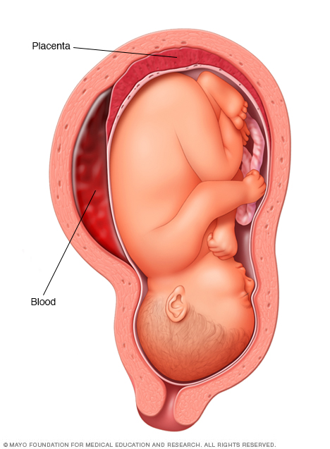 Placental abruption 