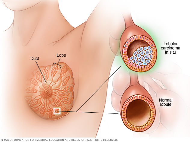 Lobular carcinoma in situ 