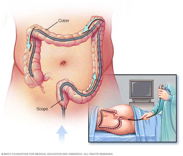 Colonoscopy exam